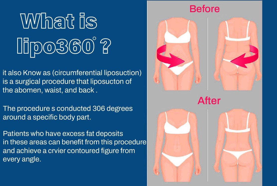 360_liposuction_in_turkey_explanation