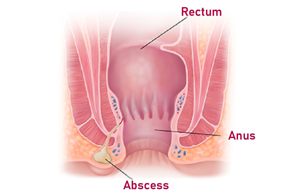 anal_fistula_for Anal_Fistula_Surgery_in_Turkey