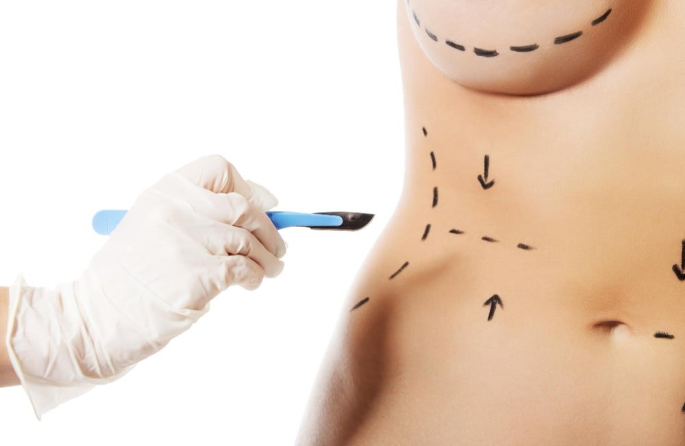 additional_touchup_lines_after_lipo