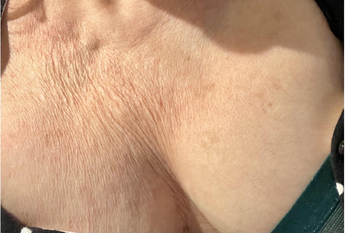 aging _decolletage _for _decolletage _rejuvenation_ in _turkey