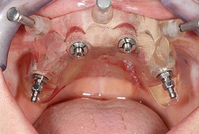 all_on_4_dental_implants_in_turkey_illustartion