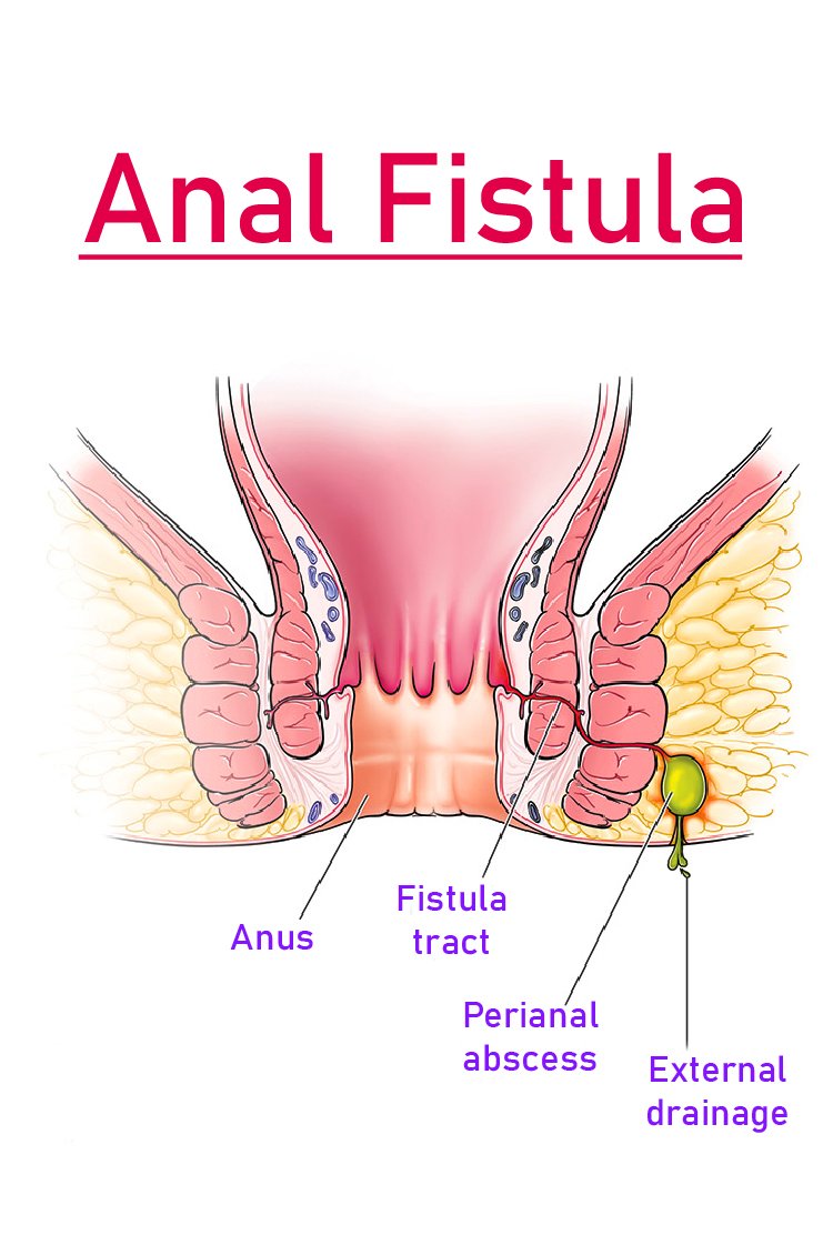 anal_fistula_for Anal_Fistula_Surgery_in_Turkey