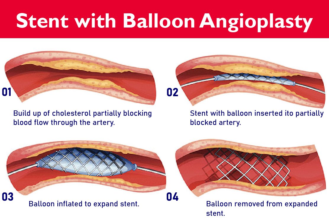 angioplasty-in-turkey-procedure