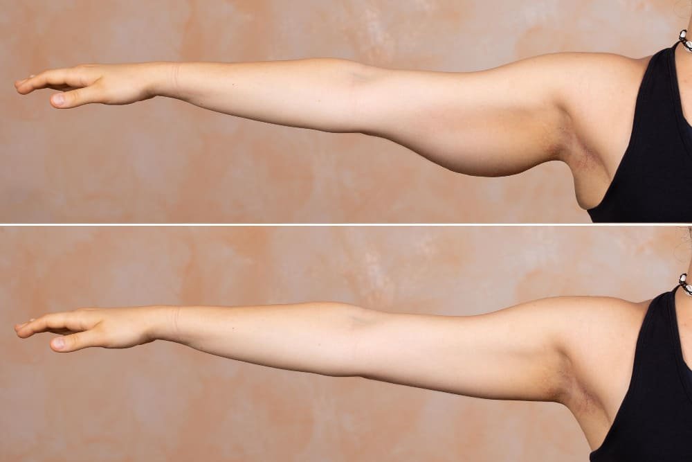 arm_skin_before_and_after_liposuction_in_turkey