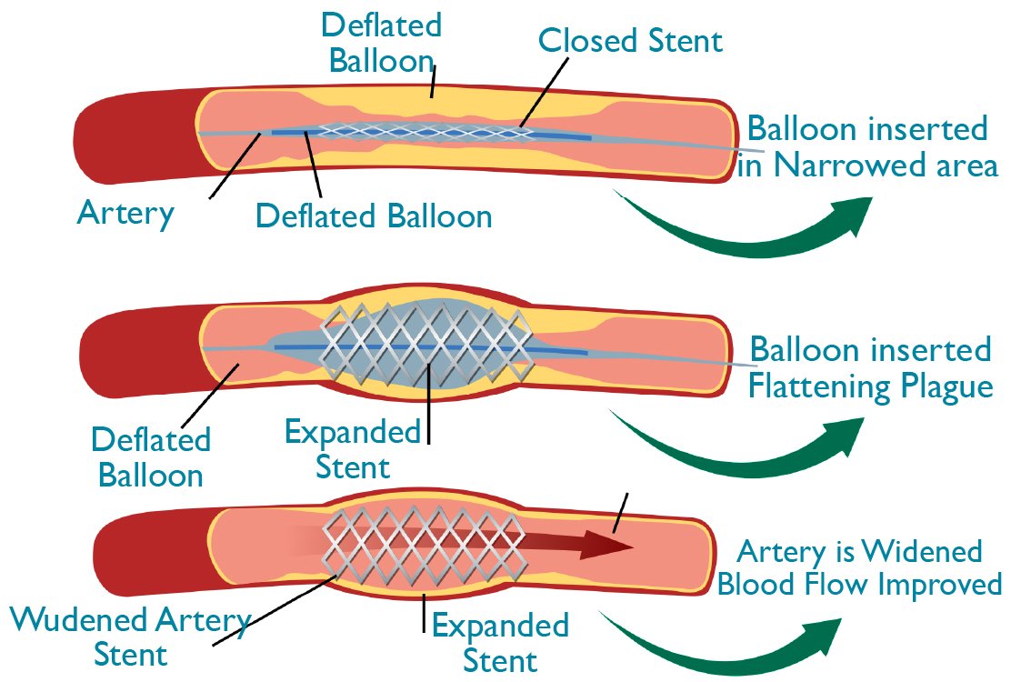 balloon-angioplasty-in-turkey
