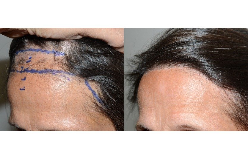 before_and_after_forehead_reduction_in_turkey_example
