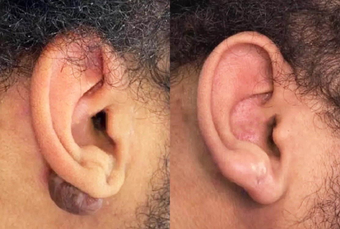 before_and_after_keloid_treatment_in_turkey