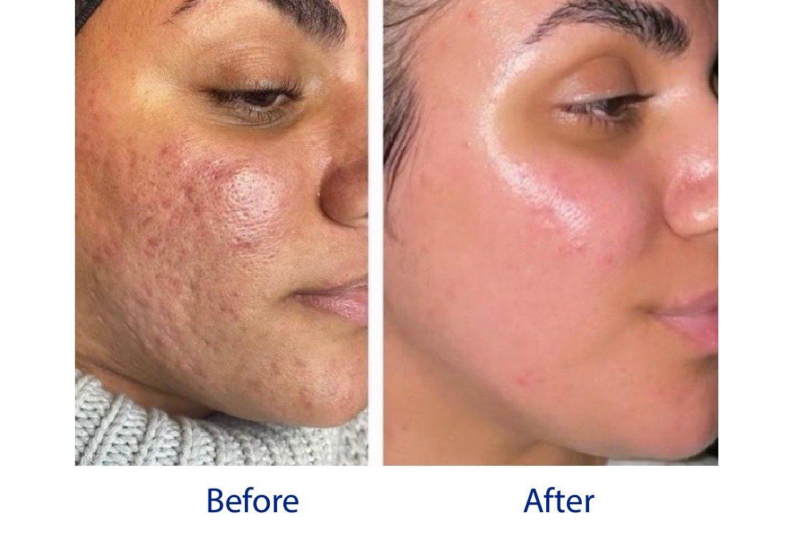 before_and_after_morpheus8_in_turkey