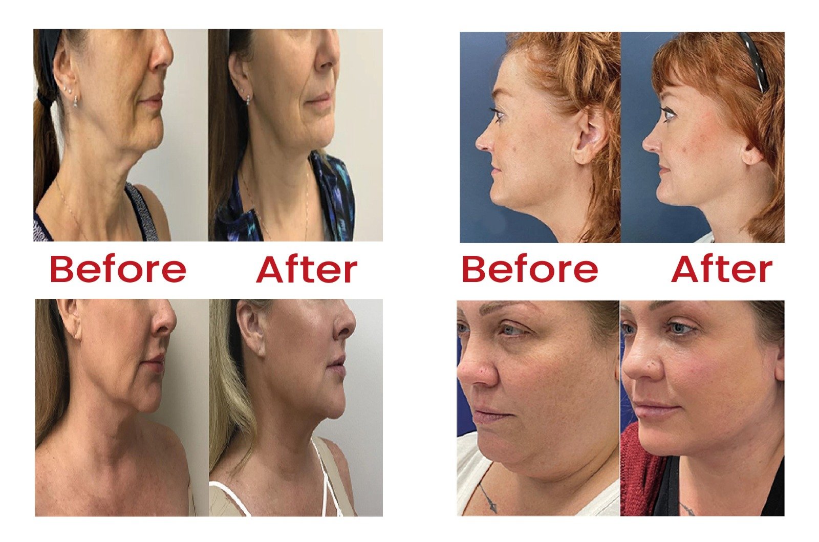 before_and_after_myellevate_in_turkey