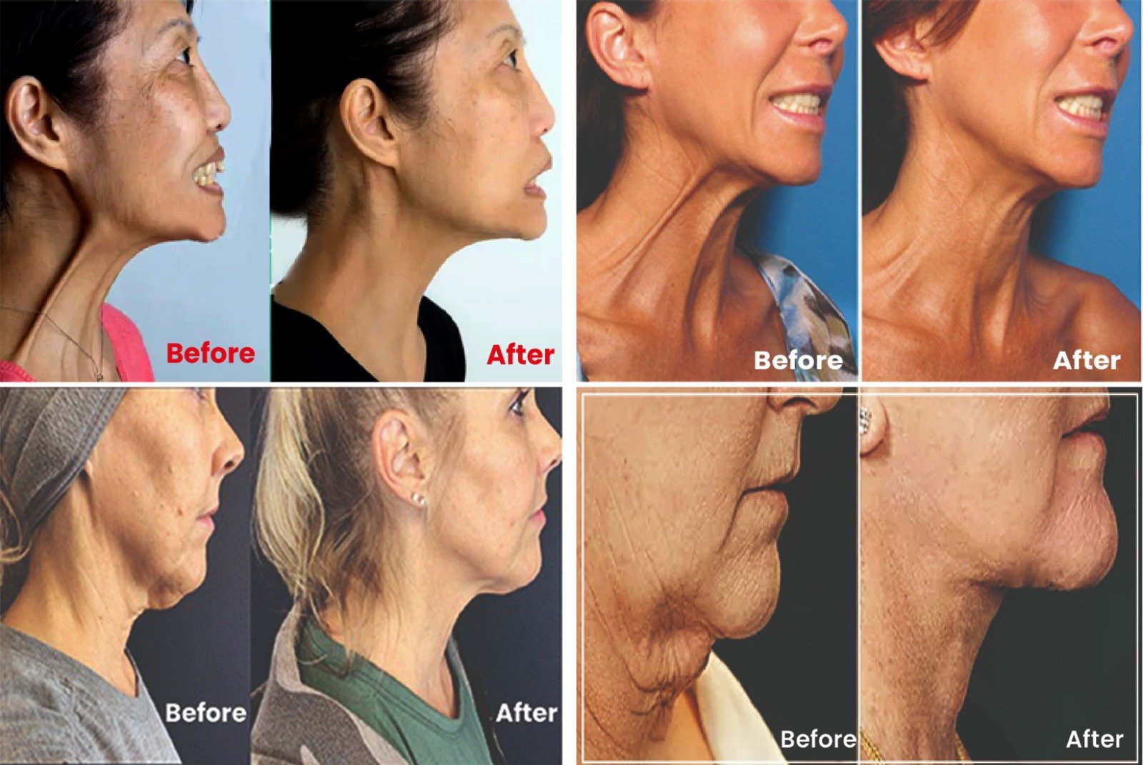 before_and_after_pictures_of_nefertiti_neck_lift_in_turkey