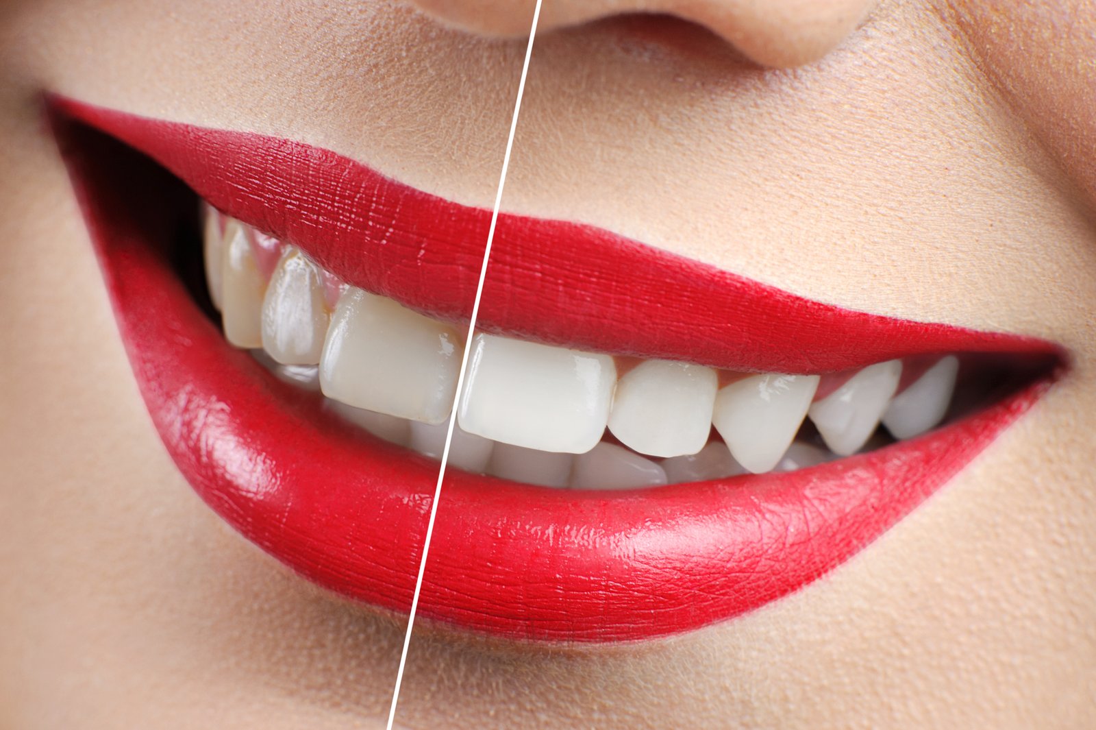 before_and_after_veneers