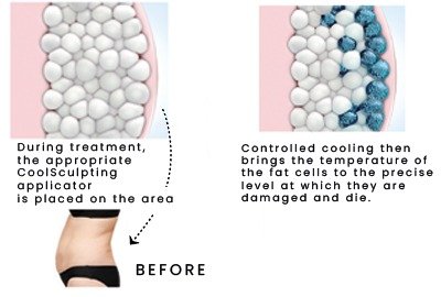 before_coolsculpting_in_turkey