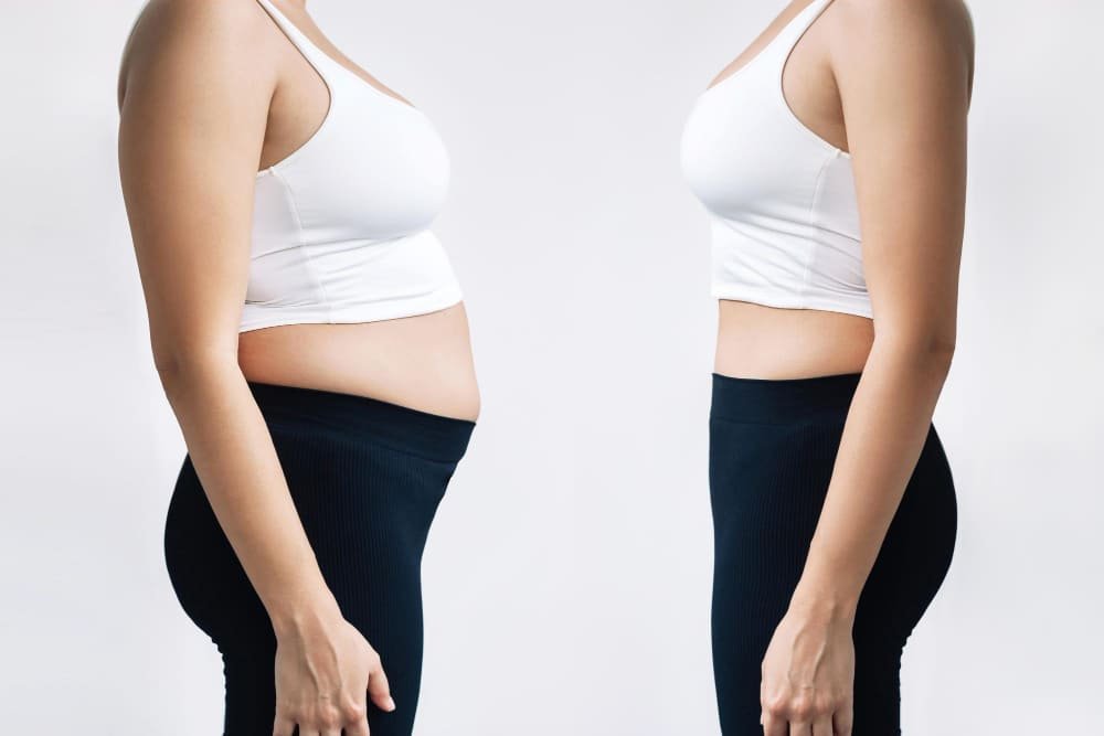 belly_fat_before_and_after_liposuction_in_turkey