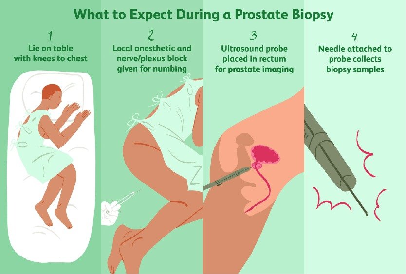 BIOPSY_test_for_prostate_cancer_diagnosis_in_turkey
