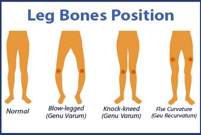 bow_legged_locked_knees_illustration_for_limb_lengthening_in_turkey