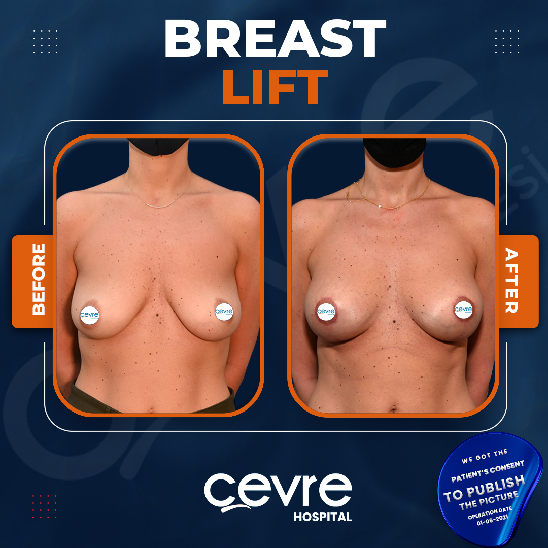 breast_lift_in_turkey_before_and_after_with_cevre_hospital (3)