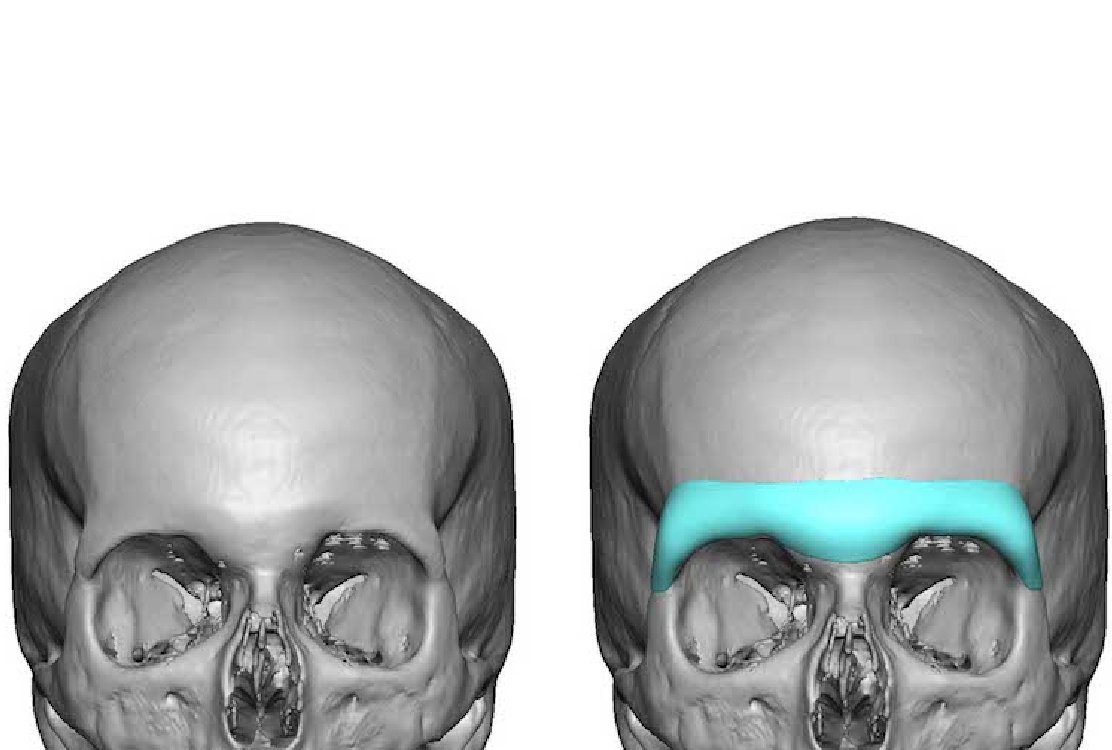 brow_bone_enhancement_for_facial masculinization_surgery_in_turkey (2)