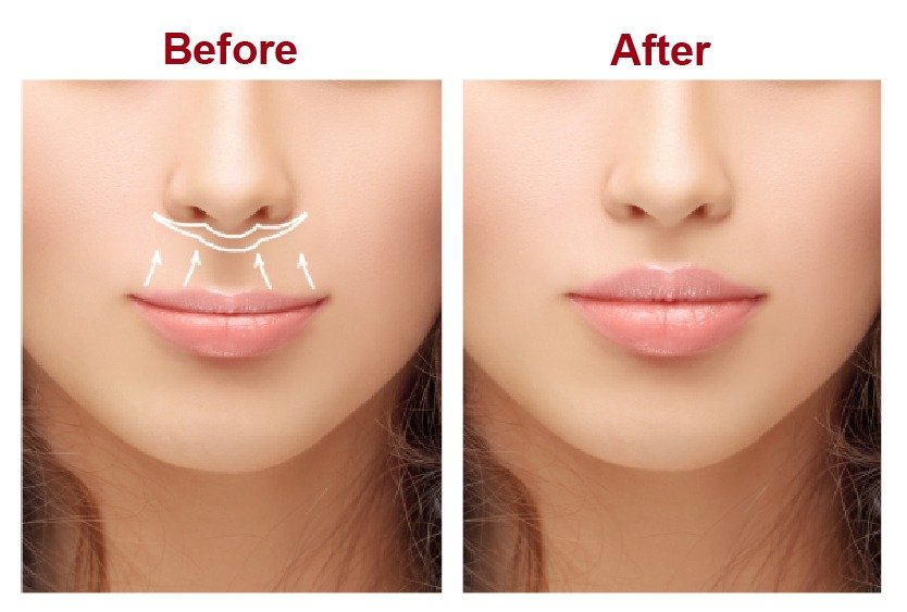 bull_horn_lip_lift_in_turkey