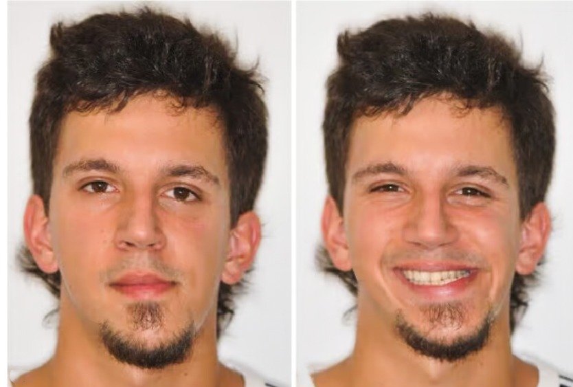 candidate_for_chin_implant_in_turkey_with_assymetrical_chin