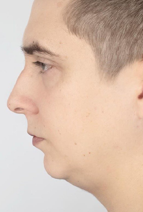 candidate_for_chin_implant_in_turkey_with_weak_jawline