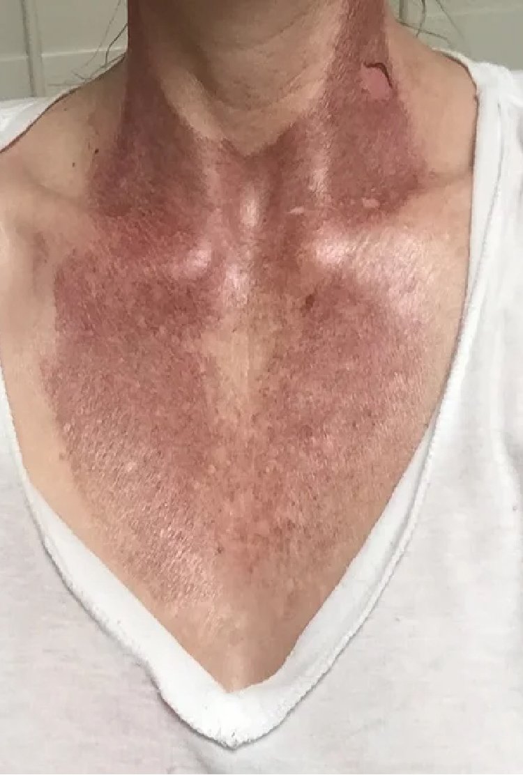 chemical _peel _for _decolletage _rejuvenation _in_turkey
