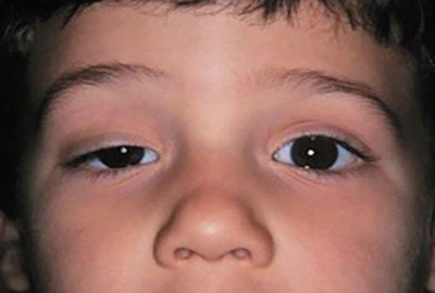 child_in_need_of_ptosis_in_turkey_surgery