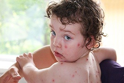 child_with_monkeypox_in_turkey