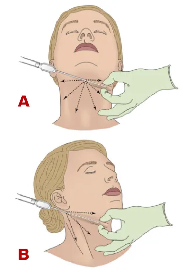 chin-liposuction-in-turkey-procedure
