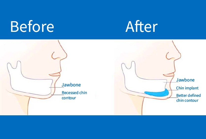 chin_implant_in_turkey_procedure