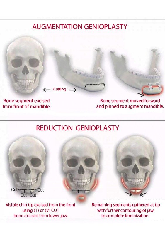 chin_implant_in_turkey_with_genioplasty (2)