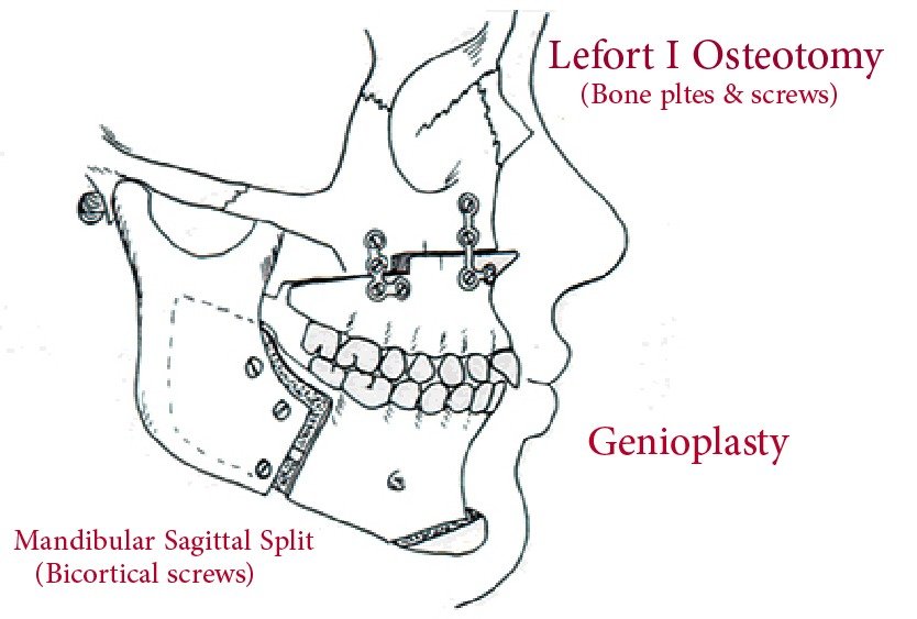 chin_implant_in_turkey_with_genioplasty