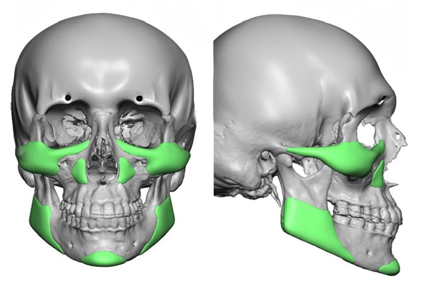 chin_implant_in_turkey_with_other_implants
