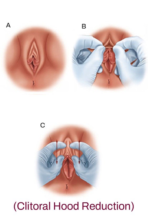 clitoral_hood_reduction_for_cosmetic_gynecology_in_turkey