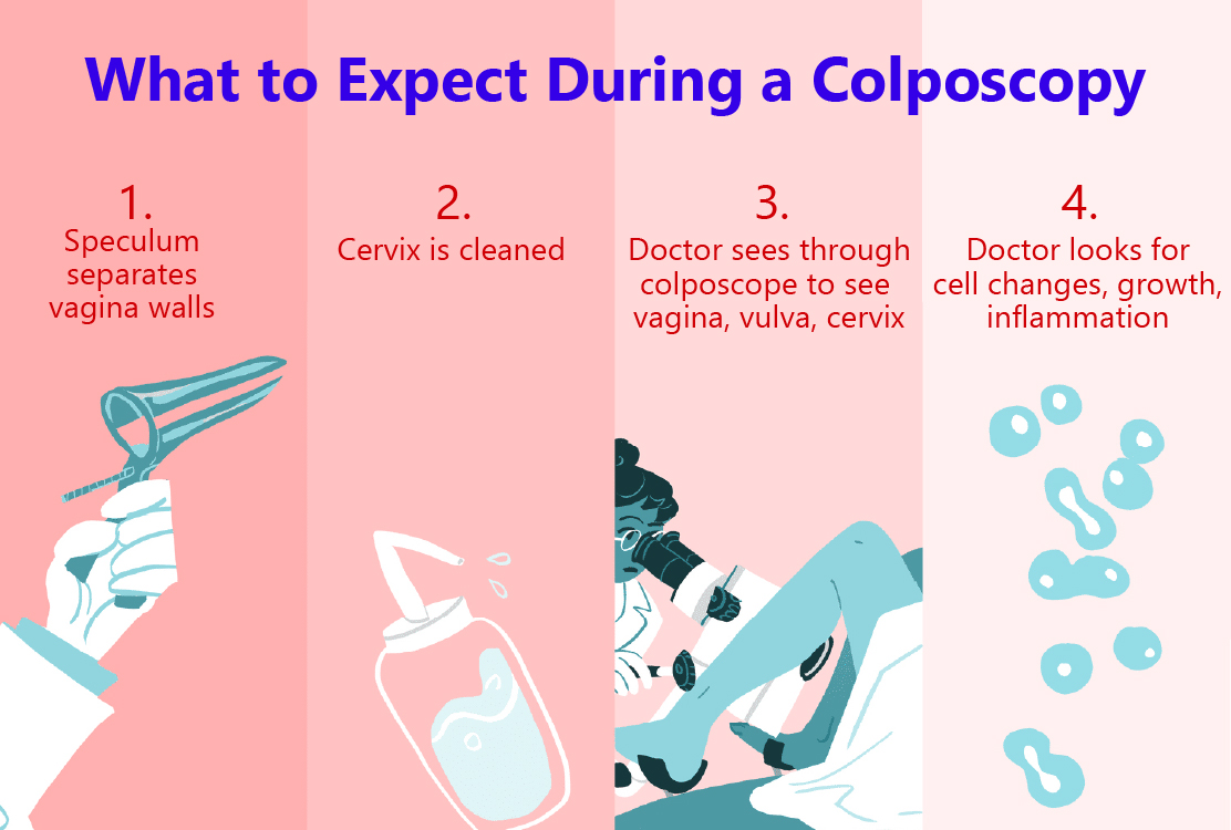 Colposcopy-in-Turkey-procedure