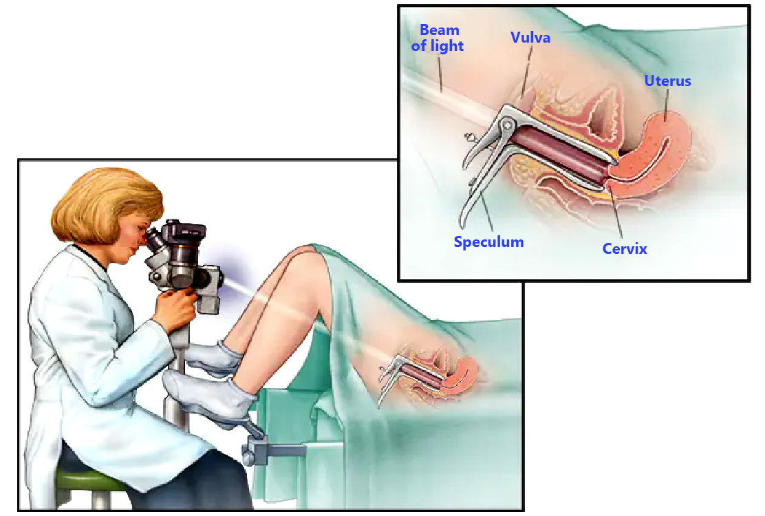 Colposcopy-in-Turkey-representation