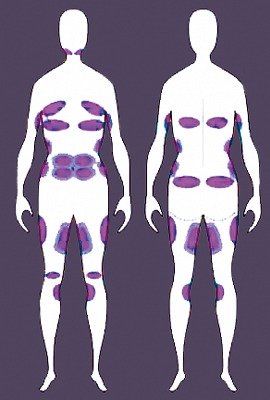 coolsculpting_in_turkey_treatment_areas