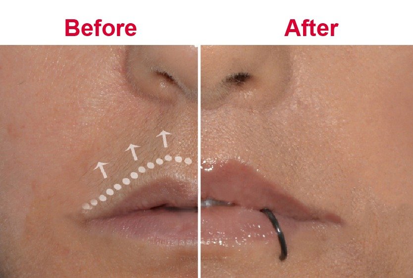 corner_lip_lift_in_turkey