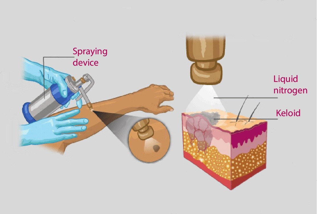 cryosurgery_for_keloid_treatment_in_turkey