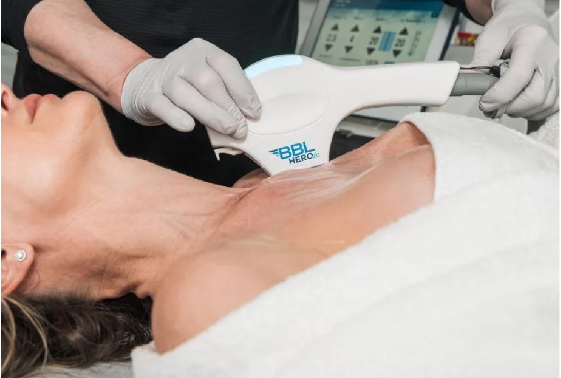 decolletage_ rejuvenation_ in _turkey _with _laser