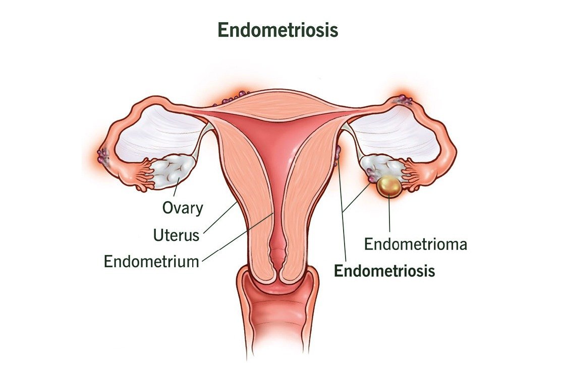 definition_of_IUI_in_turkey