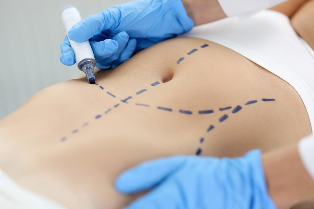 doctor_drawing_guideline_for_liposuction_part_ of_mommy_makeover_in_turkey
