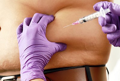 fat_man_getting_liquid_lipo