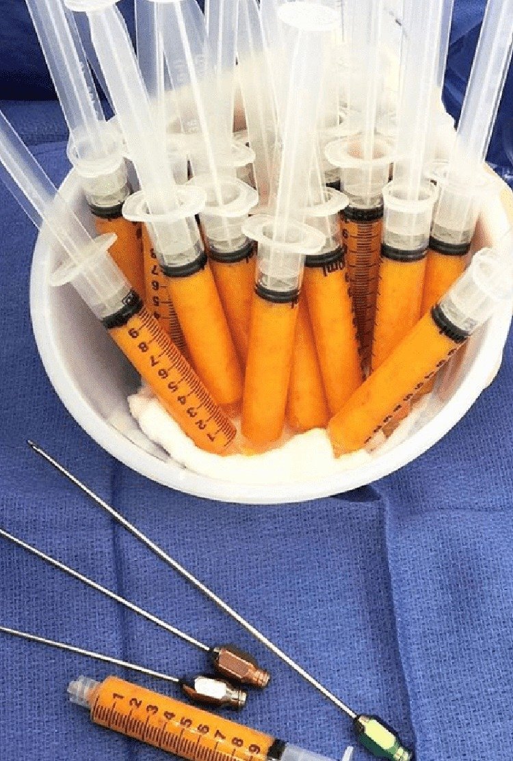 fat_transfer_for_hybrid_breast_augmentation_in_turkey