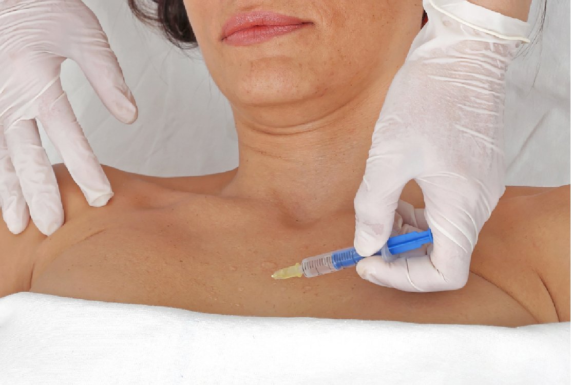 fillers_ for _decolletage _rejuvenation _in _turkey