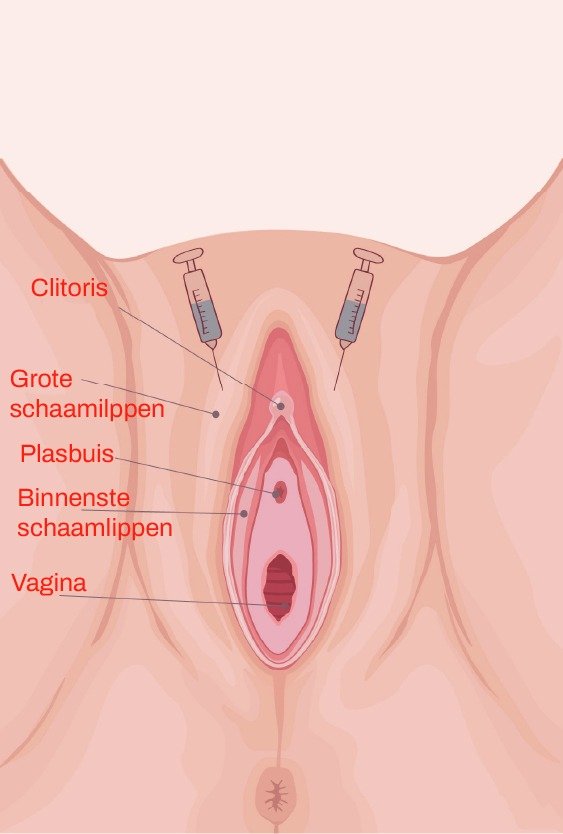 fillers_for_non_invasive_cosmetic_gynecology_in_turkey