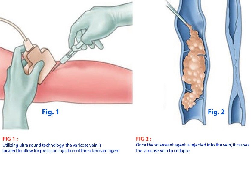 foam_therapy_for_varicose_treatment_in_turkey