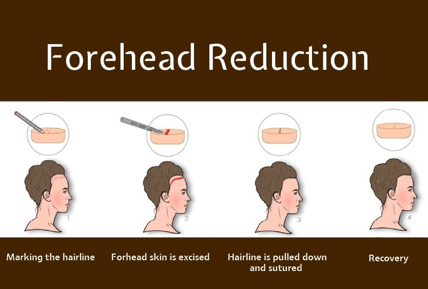 forehead_reduction_in_turkey_procedure (2)