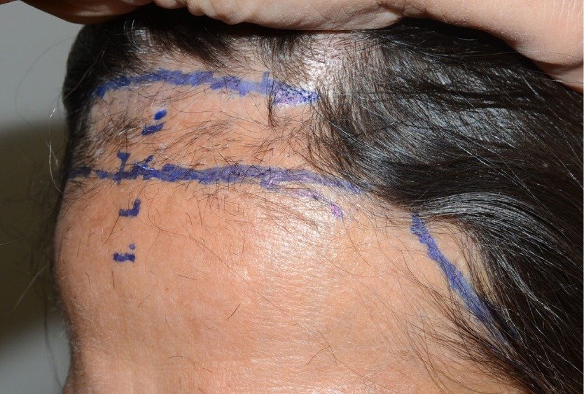 forehead_reduction_in_turkey_procedure