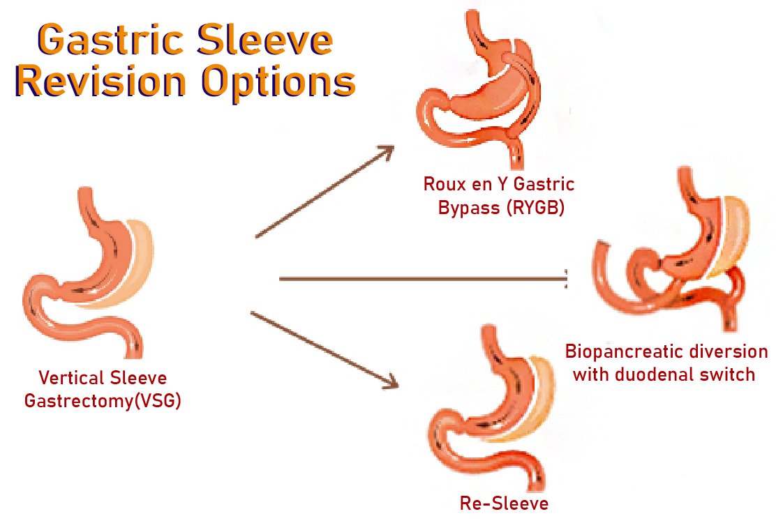 gastric _sleeve _revision_ in _turkey _options