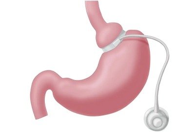 gastric_band_in_turkey_vector